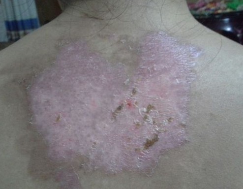 光療白癜風之后白斑部位會發紅發癢是為什么