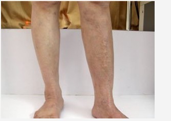 男性白癜風患者遺傳給孩子的幾率大不大