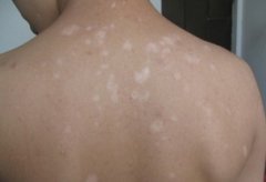 爸爸有白癜風遺傳給孩子的幾率多大?