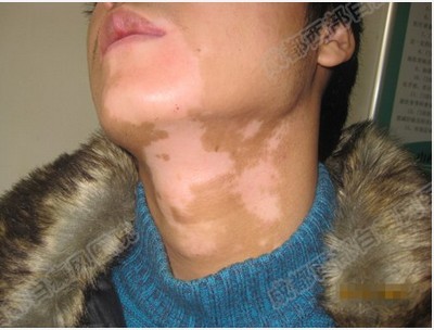 哪個年齡段的人容易患上白癜風?