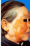 老年白癜風(fēng)患者的護(hù)理要點是什么