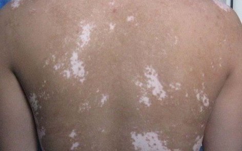 擴(kuò)散期的白癜風(fēng)有什么表現(xiàn)