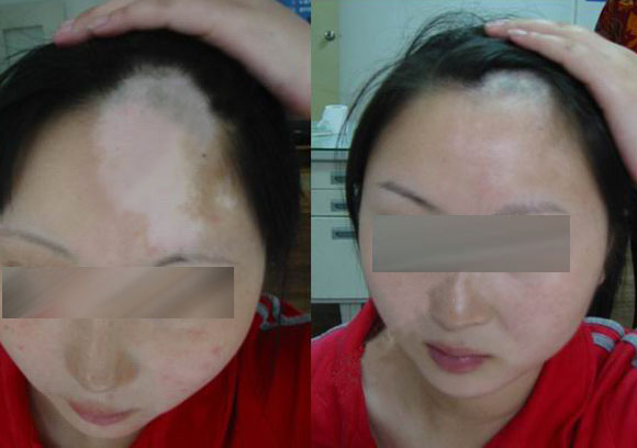 額頭白癜風.jpg