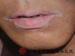 唇部白癜風(fēng).jpg
