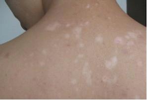 白癜風發展期要多久才能控制