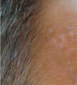 頭上的白癜風會讓頭發變白嗎