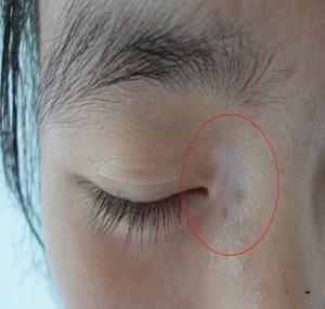 臉上的白癜風治療