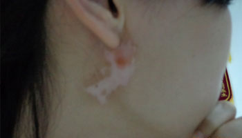 白癜風患者可以使用護膚品嗎