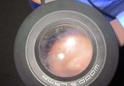 面積很小的白癜風能不能自愈