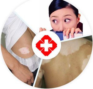 胸前的白癜風(fēng)也是可以治好嗎