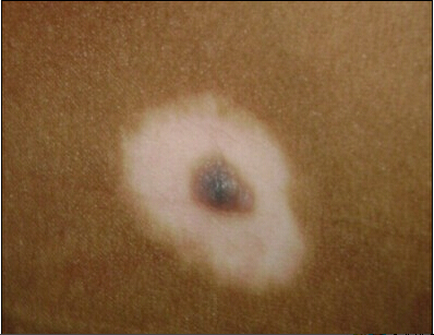 暈痣型白癜風是怎么發生的