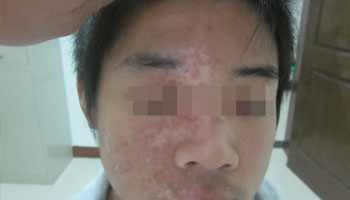 毛囊型白癜風種黑色素治療需要多久