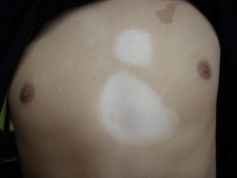 白癜風(fēng)白斑到底會不會傳染