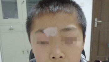 哪些因素影響白癜風