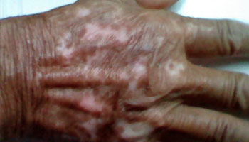老年人手上出現白癜風會擴散嗎