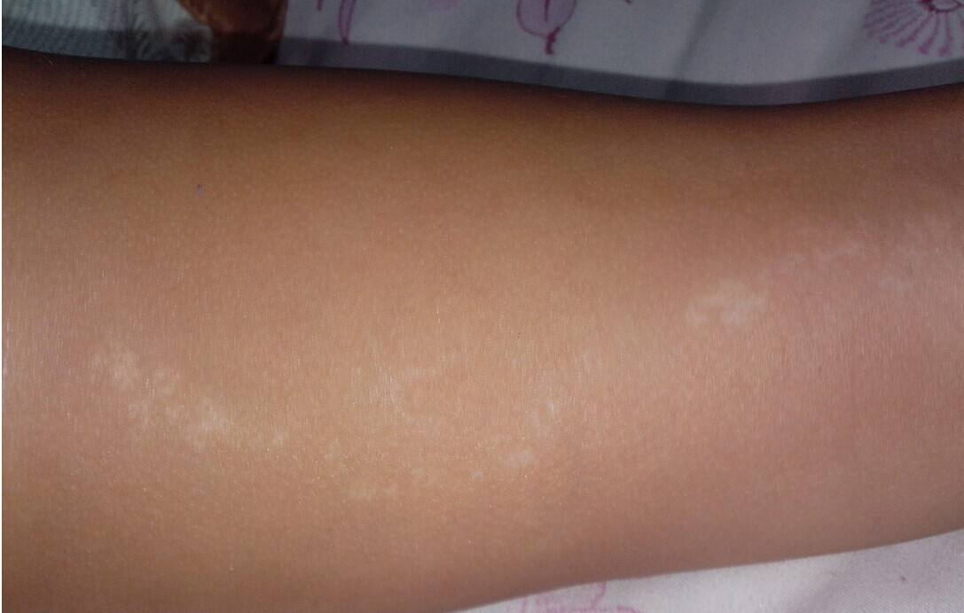 胳膊早期的白癜風能治好嗎