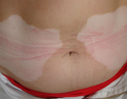 白癜風擴散白斑旁邊是不是變紅