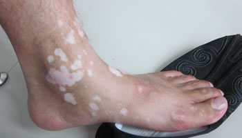 腳上有塊白癜風不治療會擴散嗎