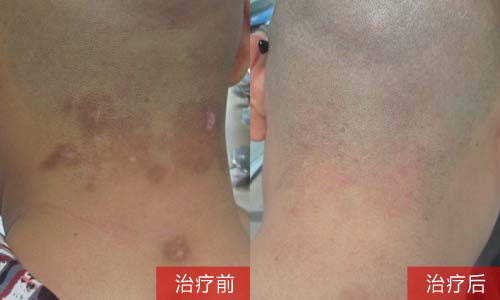 白癜風(fēng)