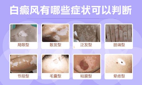 暈痣型白癜風