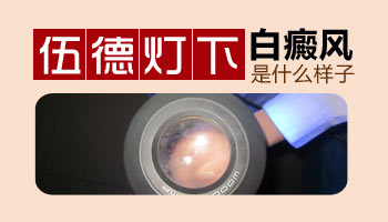 用wood燈檢查嬰兒皮膚白斑是什么有傷害嗎