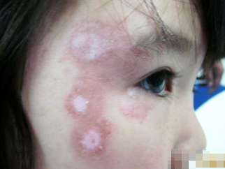 8歲兒童多處散發型白癜風治好