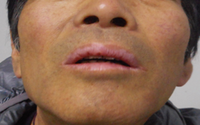 兒童面部白癜風的原因和治療方法