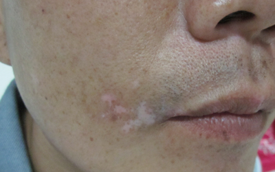 兒童白癜風好的治療方法