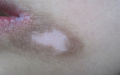 兒童局限性白癜風癥狀有什么特點