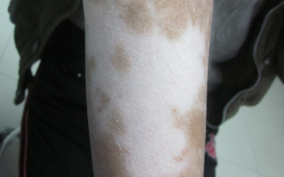 小孩白癜風使用激光治療有副作用嗎