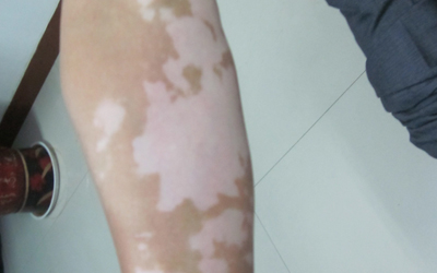 新生兒會得白癜風嗎