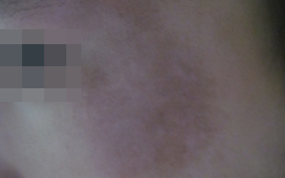 兒童得了白癜風要注意哪些事項呢