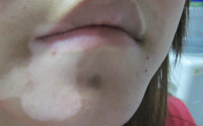 小兒白癜風(fēng)的具體癥狀是什么