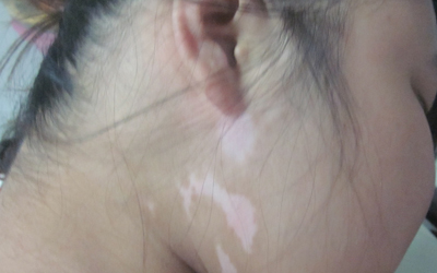 白癜風(fēng)兒童不愛吃飯需要補什么