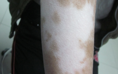 夏季兒童白癜風(fēng)如何治療好