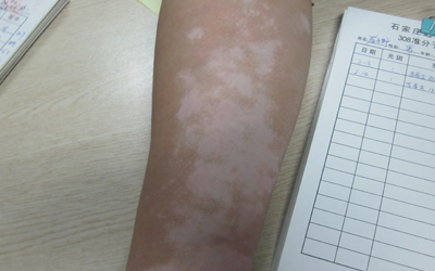 腿部白癜風如何治療