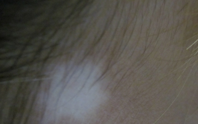 小兒白癜風(fēng)癥狀