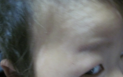 治好兒童腳部白癜風(fēng)從飲食做起