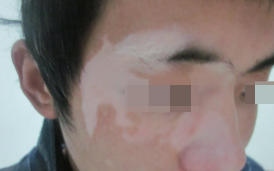 剛出生寶寶有白癜風(fēng)