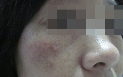 兒童泛發型白癜風有哪些癥狀