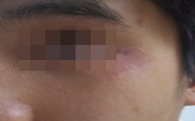 兒童白癜風的潛伏癥狀如何判斷