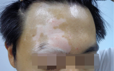 兒童白癜風(fēng)在診斷時(shí)要注意哪些誤區(qū)