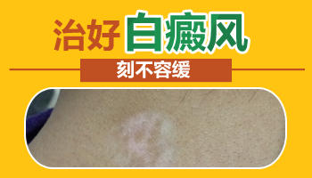 女兒得了白癜風都需要做什么檢查