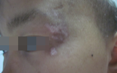 兒童面部白癜風怎么治療