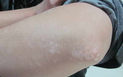 兒童白癜風(fēng)治療方法好的是哪種