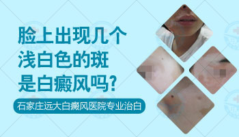 兒童為什么會患上白癜風