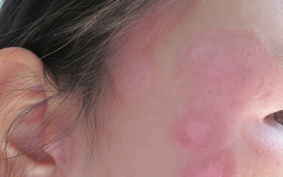 青少年白癜風怎么治好的速度快	