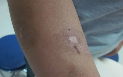 如果兒童身上長(zhǎng)白斑家長(zhǎng)怎么治療