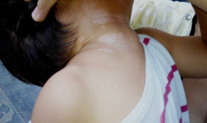 兒童脖子上的白癜風怎么治療比較好