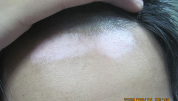 黑色素種植能治療小兒白癜風嗎